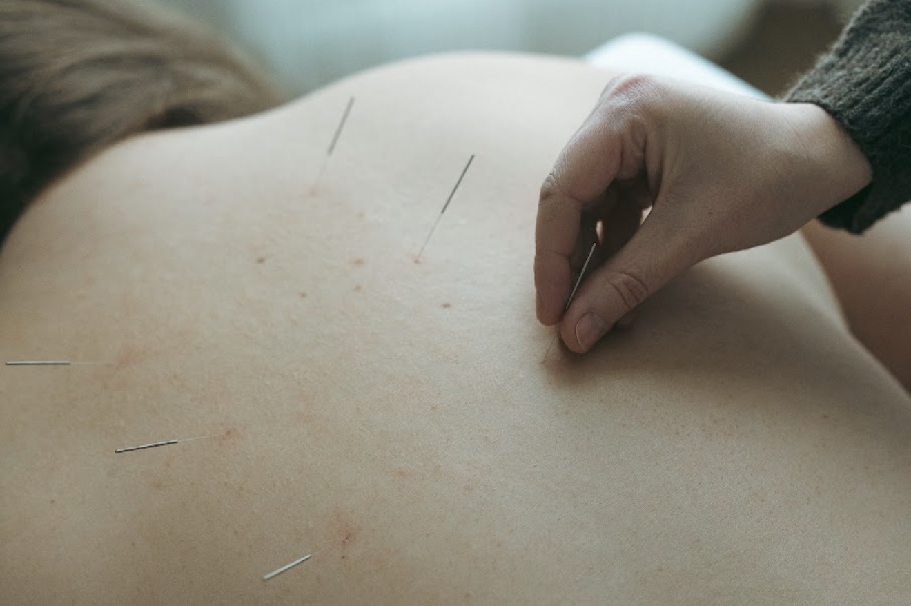 Acupuncture treatment